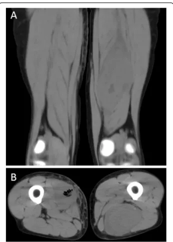 Fig. 1 CT scan views of the thigh abscesses. The infection presents as an isodense image located within the muscles with a small necrotic centre