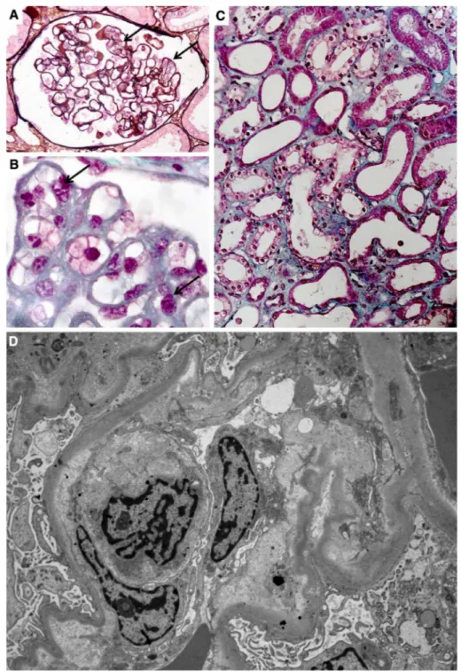 Fig. 1    Endotheliosis is defined  by endothelial changes in renal  glomeruli, combined with  swol-len endothelial cells leading to  narrowed capillary lumen (a, b)