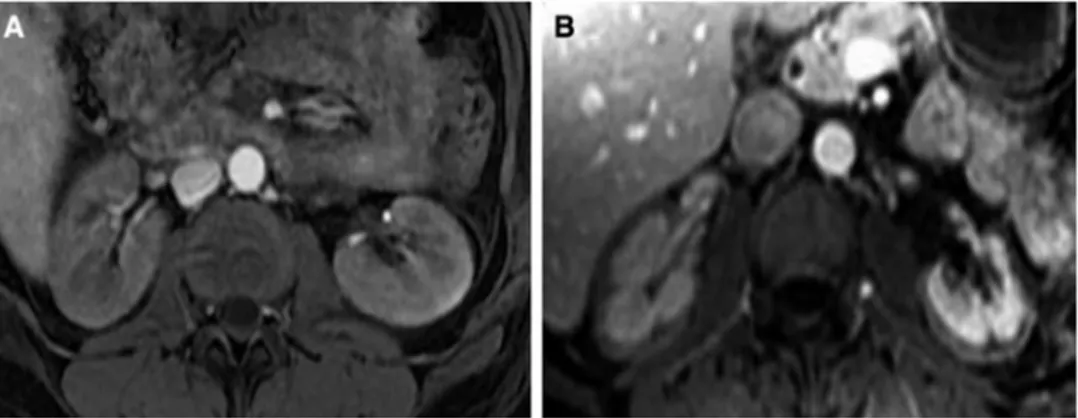 Fig. 2    MRI T1 weighted with  gadolinium contrast. When  compared to the normal aspect  of the kidney (a), renal cortical  necrosis is characterized by the  absence of enhanced contrast  in the cortex (b)
