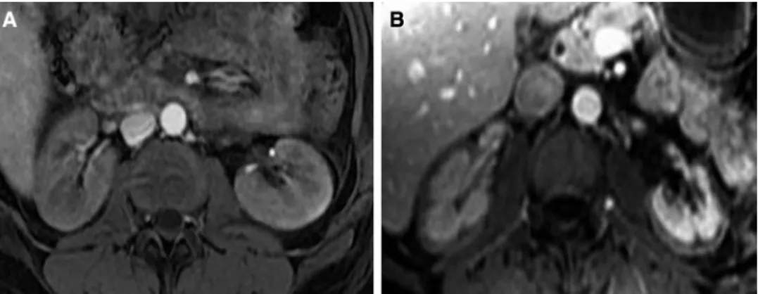 Fig. 2    MRI T1 weighted with  gadolinium contrast. When  compared to the normal aspect  of the kidney (a), renal cortical  necrosis is characterized by the  absence of enhanced contrast  in the cortex (b)