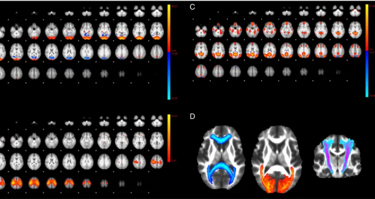 Fig. 1. (A, B and C) show selected independent component analysis maps from resting-state networks of healthy controls that correspond to the (A) visual, (B) sensorimotor, and (C) default mode networks