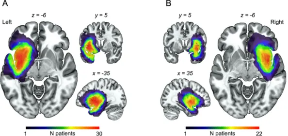 Fig. 1. Lesion overlap map for (A) left insular glioma and (B) right insular glioma patients