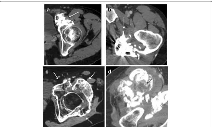 Fig. 1 Axial CT images in four different patients. a anterior osteoma (arrow). b posterior osteoma (arrow)