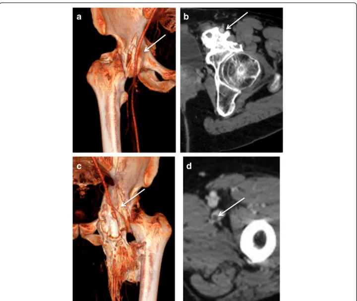 Fig. 2 Enhanced-CT in volume rendering reconstruction (a and c) and axial images (b and d) illustrating the different types of relationships between osteomas and femoral arteries