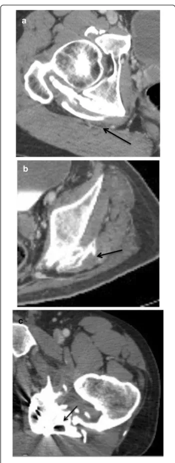 Fig. 3 Axial images of a biphasic enhanced CT in three different patients with posterior osteomas with various types of relationships with sciatic nerves