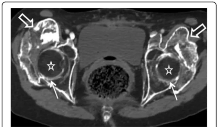 Fig. 4 Coronal reconstruction of CT scan: neurogenic osteoarthropathy of the right hip (a) and left hip (b, other patient)