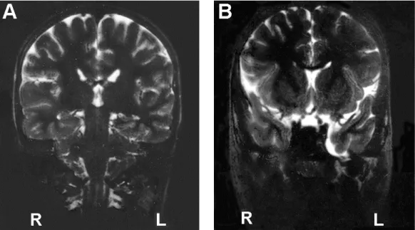 Figure 3  Brain MRI of the patient with the WBCR duplication showing mild dilatation of the left temporal  horn (A) and a small arachnoid cyst in the temporal fossa (B)