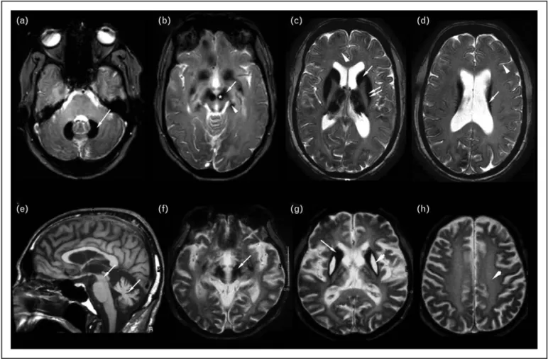 FIGURE 4. Aceruloplasminemia and neuroferritinopathy. (a–d) A 60-year-old female patient with aceruloplasminemia after 7 years of disease duration