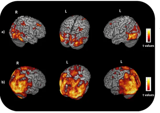 Fig. 1. Voxel-based morphometry and voxel-based metabolism results showing patterns of atrophy (A) and  hypometabo-lism (B) in six PCA patients relative to 15 healthy controls
