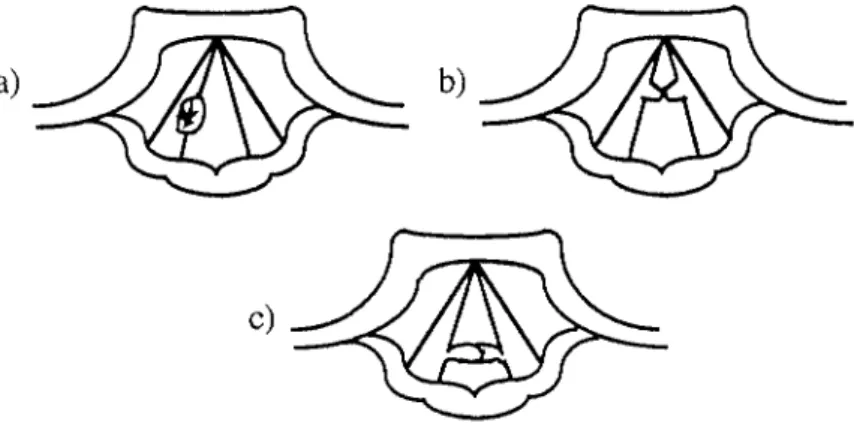 Figure 2-2. Exemples de tumeurs bénignes des cordes vocales a) kyste de la corde vocale droite