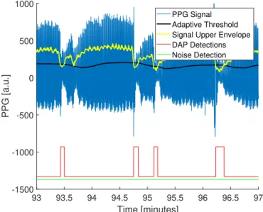 Fig. 2. The DAP detection method applied on a PPG signal. The threshold was computed with U p = 70%.