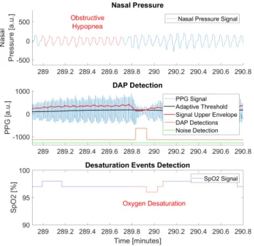 Fig. 3. Apneic and hypopneic events detection. Starting from the top: the first figure shows the nasal pressure signal, where the red portion highlights an annotated obstructive hypopnea event; the second plot visualizes the PPG signal with DAP detections;