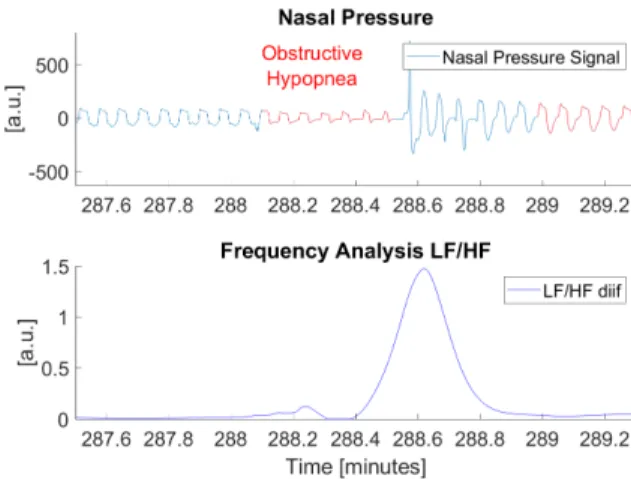 Fig. 5. This figure shows a sympatho-vagal arousal in the LF/HF, linked to an obstructive hypopnea occurrence.