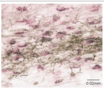 FIGURE 2 | The tecto-thalamo-striatal projection. Thalamo-striatal neurones  in the central medial nucleus of the thalamus labeled with CTb (purple)  retrogradely transported from the striatum, surrounded by terminal boutons  labeled with biotinylated dext