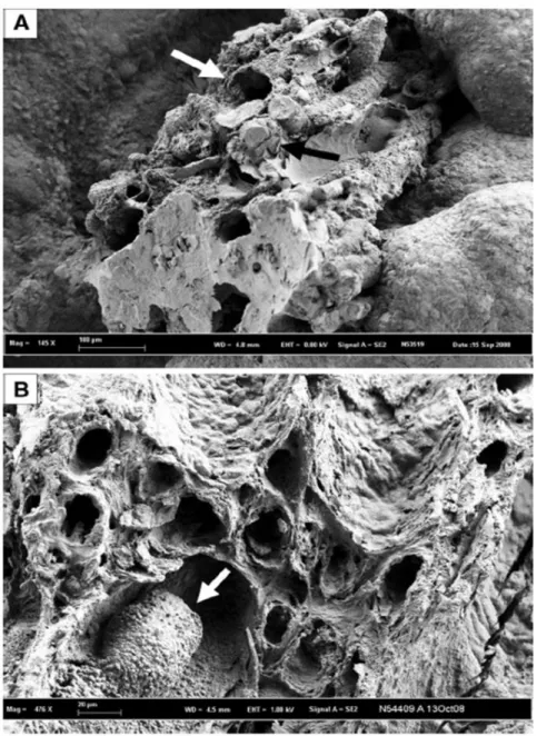 Fig. 1 Scanning electron microscopy photographs of calcium oxalate calculi initiated from a Randall’s plaque
