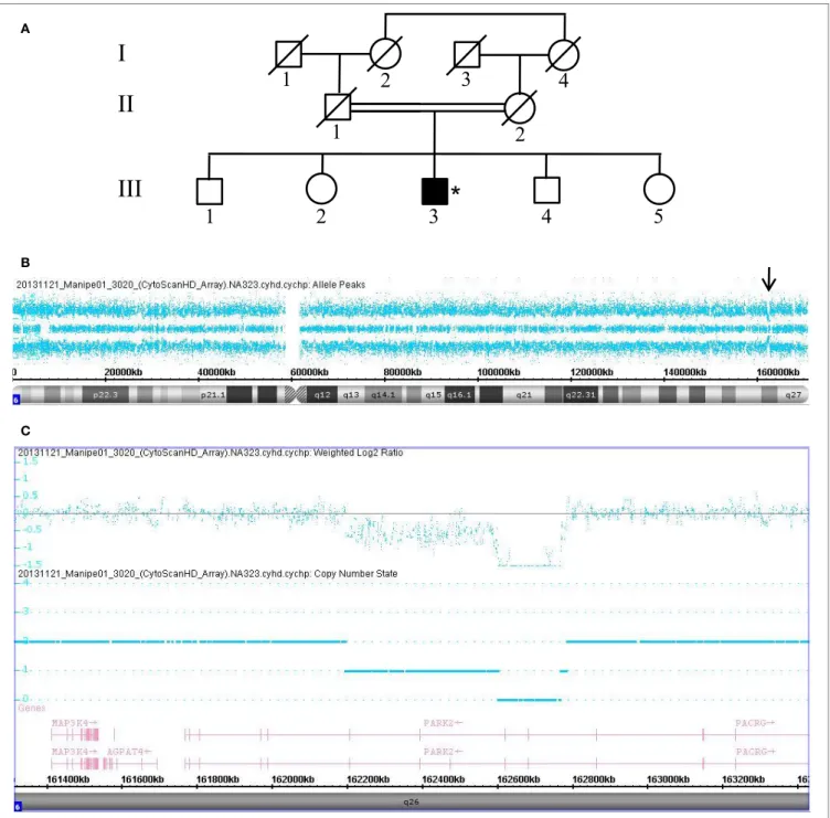 FigUre 1 | Chromosomal microarray analysis showing two compound heterozygous deletions in PRKN