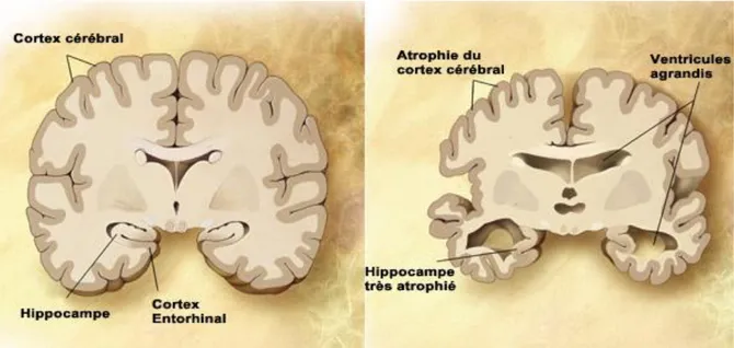 Figure 3 : Représentation schématique d’une coupe transversale de cerveau sain (à gauche) et de l’atrophie  massive d’un cerveau à un stade avancé d’Alzheimer (à droite)