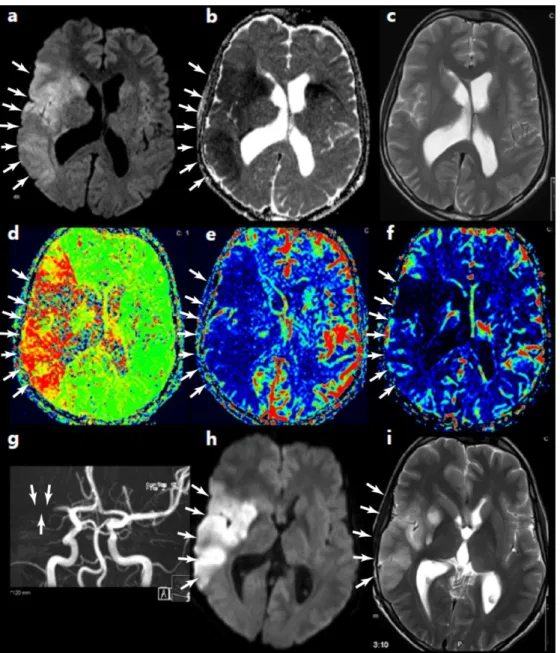 Figure  2.15:  A  classical  combined  application  of  MRI  protocols  for  a  hyperacute  MCAo  in  the  right  hemisphere
