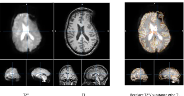 Figure 4.3 – Exemple d’échec de pré-traitement dans un cas de syndrome des trépanés