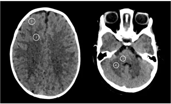 Figure 2: Examples of axial CT scan slices of the supratentorial space of the group 1 (image  A,  CTDIvol  =  32.2  mGy)  and  the  group  2  after  activation  of  an  automatic  tube  potential  selection (image B, CTDIvol = 18.7 mGy)