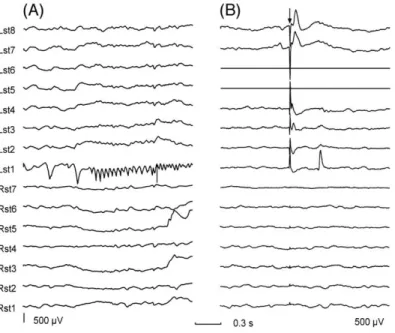 Fig. 6 Réponses précoces et tardives induites par une seule stimulation (ECoG). (A) Le début de crise épileptique focale est  bien visible sur l'électrode Lst1 (lobe sous-temporal gauche)