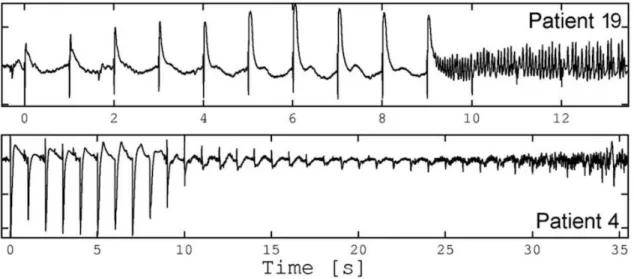 Fig.  12  Plasticité  neuronale  induite  par  une  stimulation  répétée  à  1  Hz.  Pour  le  patient  19  (en  haut,  électrode  dans  l'hippocampe postérieur), l'amplitude des réponses augmente (&#34;short-term potentiation&#34;) alors que pour le patie
