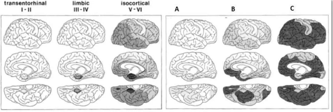 Figure 6: Evolution of the spatial distribution of NFTs and senile plaques during AD (adapted from Braak and Braak, 1991)