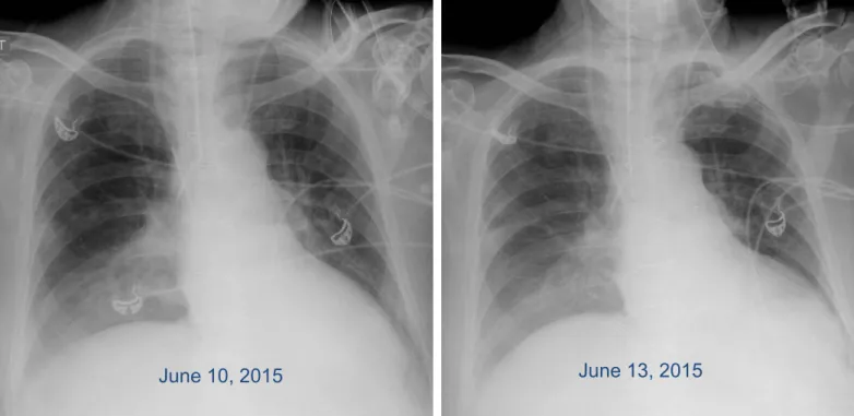 Fig. 2 Chest radiographs obtained during the days preceding suspected pneumonia: no clear- clear-cut progression of the radiographic abnormalities could be discerned when the earlier films  were compared with that obtained on the day pneumonia was suspecte
