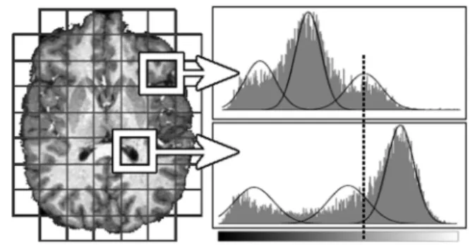 Fig. 2. Variations in local distribution of intensity. The two histograms corresponding to two different subvolumes illustrate the intensity variation for each tissue class