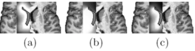 Fig. 4. Example of fuzzy Maps of Spatial Relations for the left caudate nucleus: (a) expresses “approximately at 5mm from the left frontal horn”, (b) expresses “in a direction (−3π/4, π/2) in the Talairach system with respect to the left frontal horn”, and