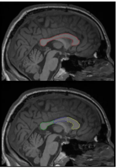 Figure 2. Example of single (top) and 3-division (bottom) partitioning of the corpus callosum