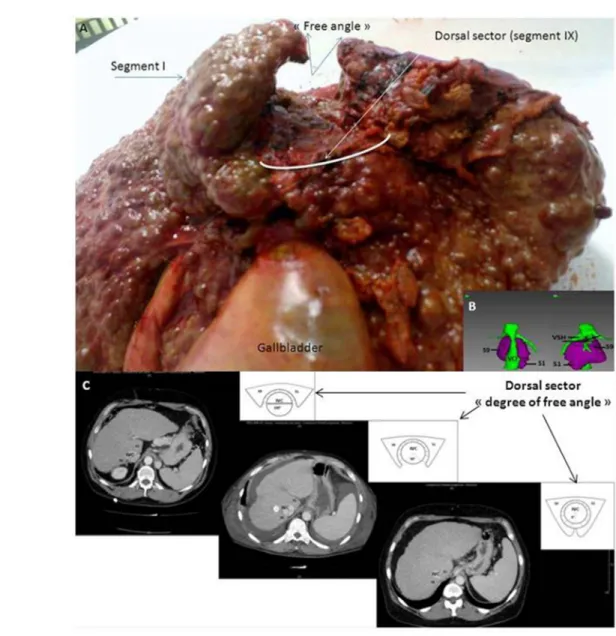 Figure  1  A,B,C: A) Segment I (arrow) and dorsal sector (segment IX, arrow) view of a  cirrhotic  native liver after a total  hepatectomy