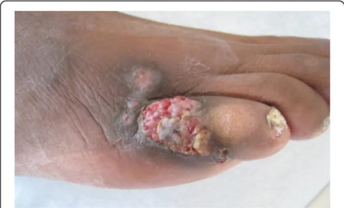 Fig. 1 Lesion due to Neoscytalidium dimidiatum in a kidney transplant recipient