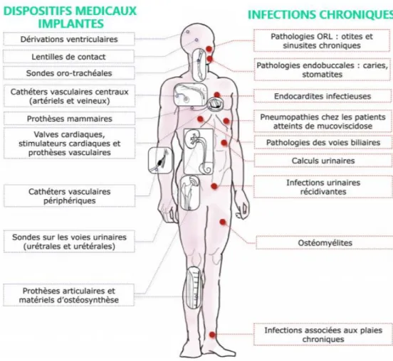 Figure  1.  Liste  non  exhaustive  des  types  de  dispositifs  médicaux  implantés  ainsi  que  des  infections  sévères  associées  à  la  présence  de  biofilms  bactériens