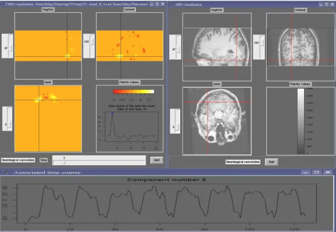 Figure 2: Image Display. Right top: Anatomical image (clockwise: sagittal, coronal and axial views)