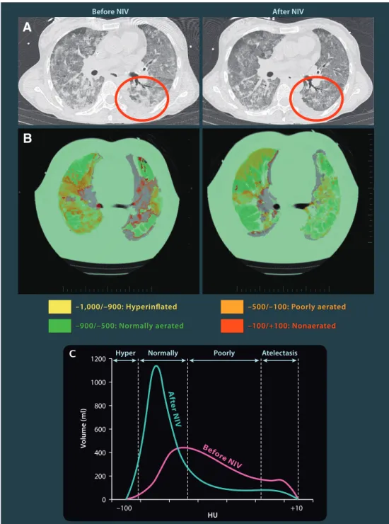 Fig. 2. Effects of postoperative noninvasive ventilation (NIV) on computed tomography (CT) lung volumes in patients with acute respiratory failure after abdominal surgery