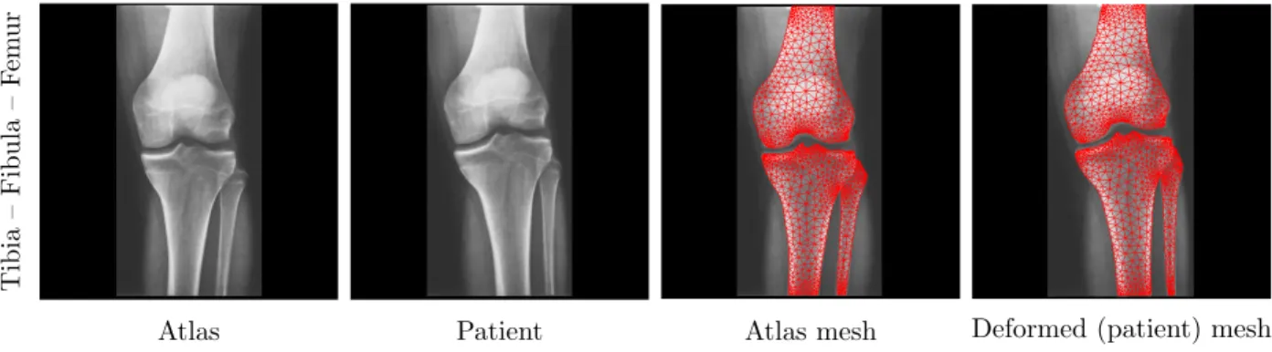 Figure 4. Atlas and patient images of a knee. Atlas meshes are deformed to fit the patient- patient-specific domain.