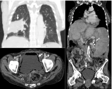 Figure 1. (Top left panel) Coronal contrast-enhanced computed to- to-mography (CT) reveals a large alveolar condensation area in the right inferior lobe (arrow)