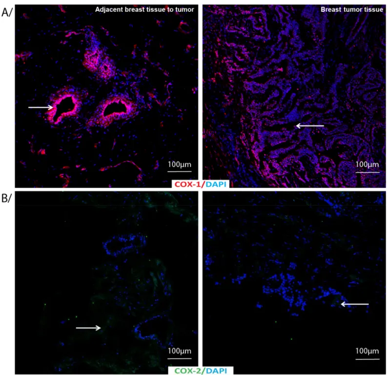 Fig 4. COX-1 and COX-2 immunostaining in adjacent breast tissue to tumor or breast tumor tissue