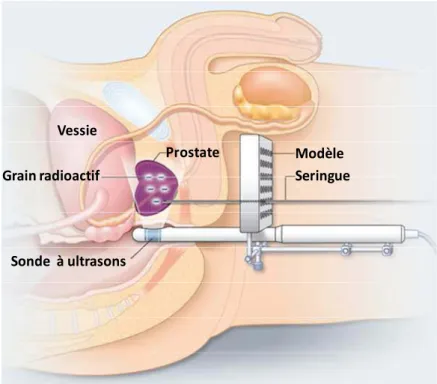 Figure 11 : Traitement d’un cancer de la prostate par brachythérapie (ou curiethérapie)  