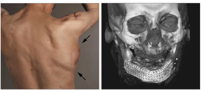 Figure 2.4 – Left : Dorsal view of mandibular replacement 3 weeks after implantation.