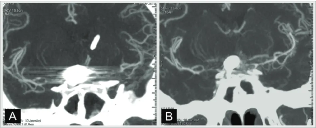 Fig. 10. Using DEACT (B) removes most of artefacts visible on current CT acquisition (A); 