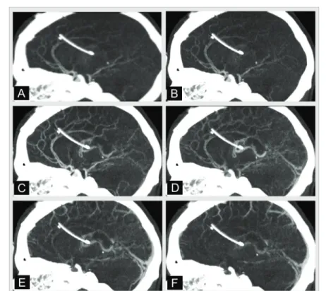 Fig. 12. Dynamic CT acquisitions show the circulation of iodinated contrast agent in the  vessels: from arterial time (A) to venous time (F)