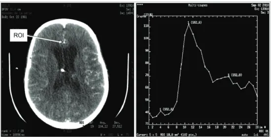Fig. 5. Time-concentration curve. The anterior cerebral artery is generally choosen as the  input artery (ROI, left), and time-concentration curve is generated from data within the ROI  pixels (right; in this example the ROI comprises 102 pixels; x-axis, i