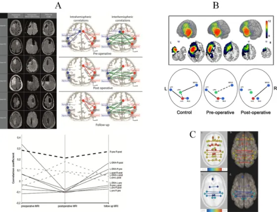 Figure 1. Serial fMRI before and after LGG resection (A): perioperative motor reorganization (from  [106])