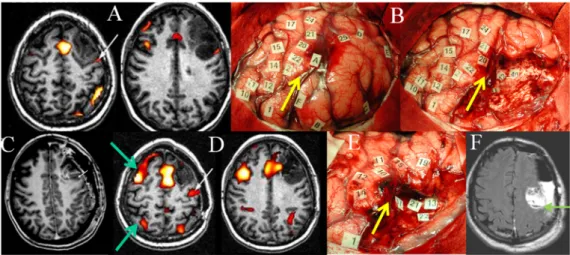 Figure 2.  Illustration  of  remapping  in  the  same  patient  demonstrated  by  serial  FNI  and  DEM  mappings