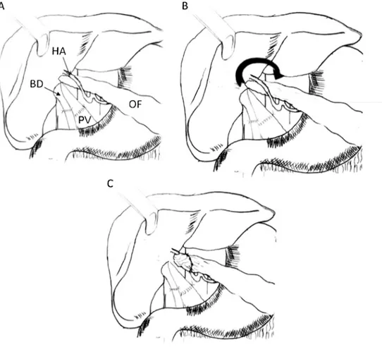 Fig. 1 a Omental flap pull behind the hepatic artery (HA). b Omental flap (OF) turned around (arrow) the hepatic artery