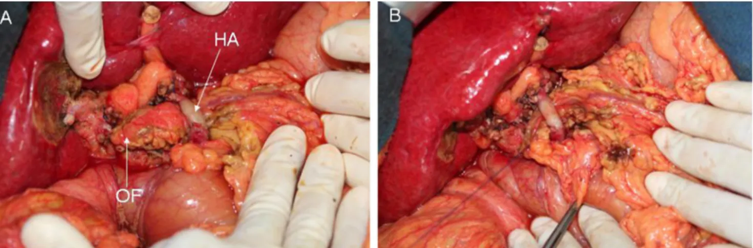 Fig. 2 Intraoperative view. a The omental flap (OF) is passed behind the hepatic artery (HA)