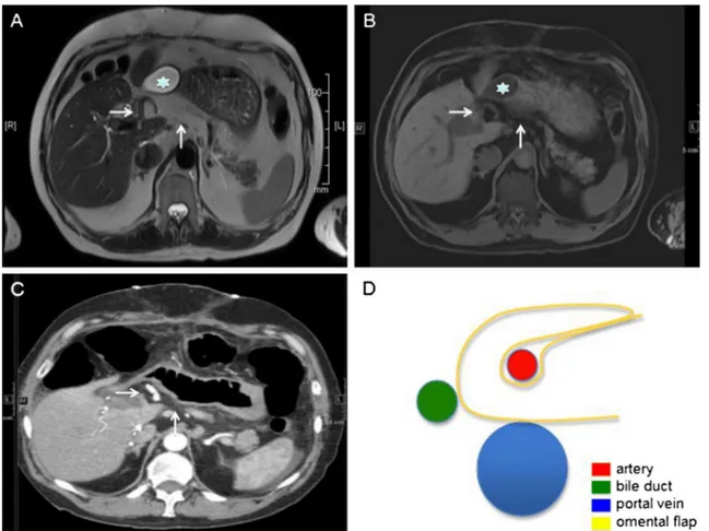 Fig. 3 Imaging (MRI (a, b), CT scan (c), and sketch (d) of the omentoplasty). Star indicates bile collection, horizontal arrow artery, and vertical arrow omental flap