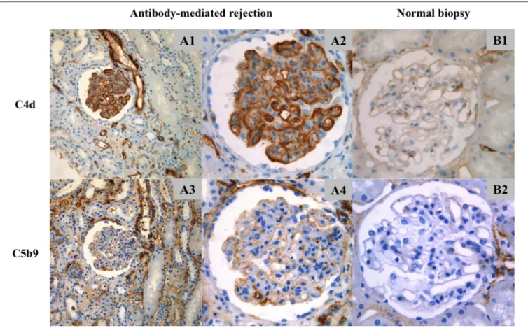 FIGURE 2 | Location of C4d and C5b9 deposits by immunohistochemistry. (A1–A4) ABMR biopsy and (B1,B2) normal biopsy